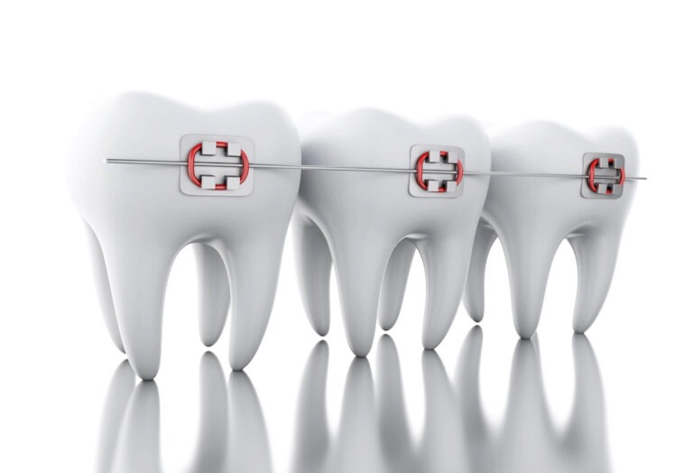 braces near me